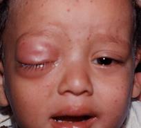 Intraocular retinoblastoma initially misdiagnosed as primary orbital cellulitis: A case report